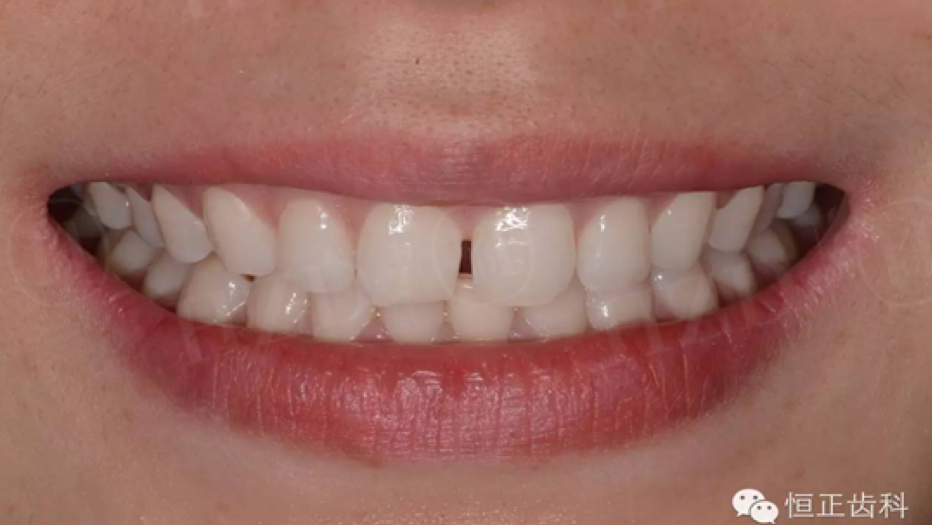 恒正病例:前牙超薄贴面