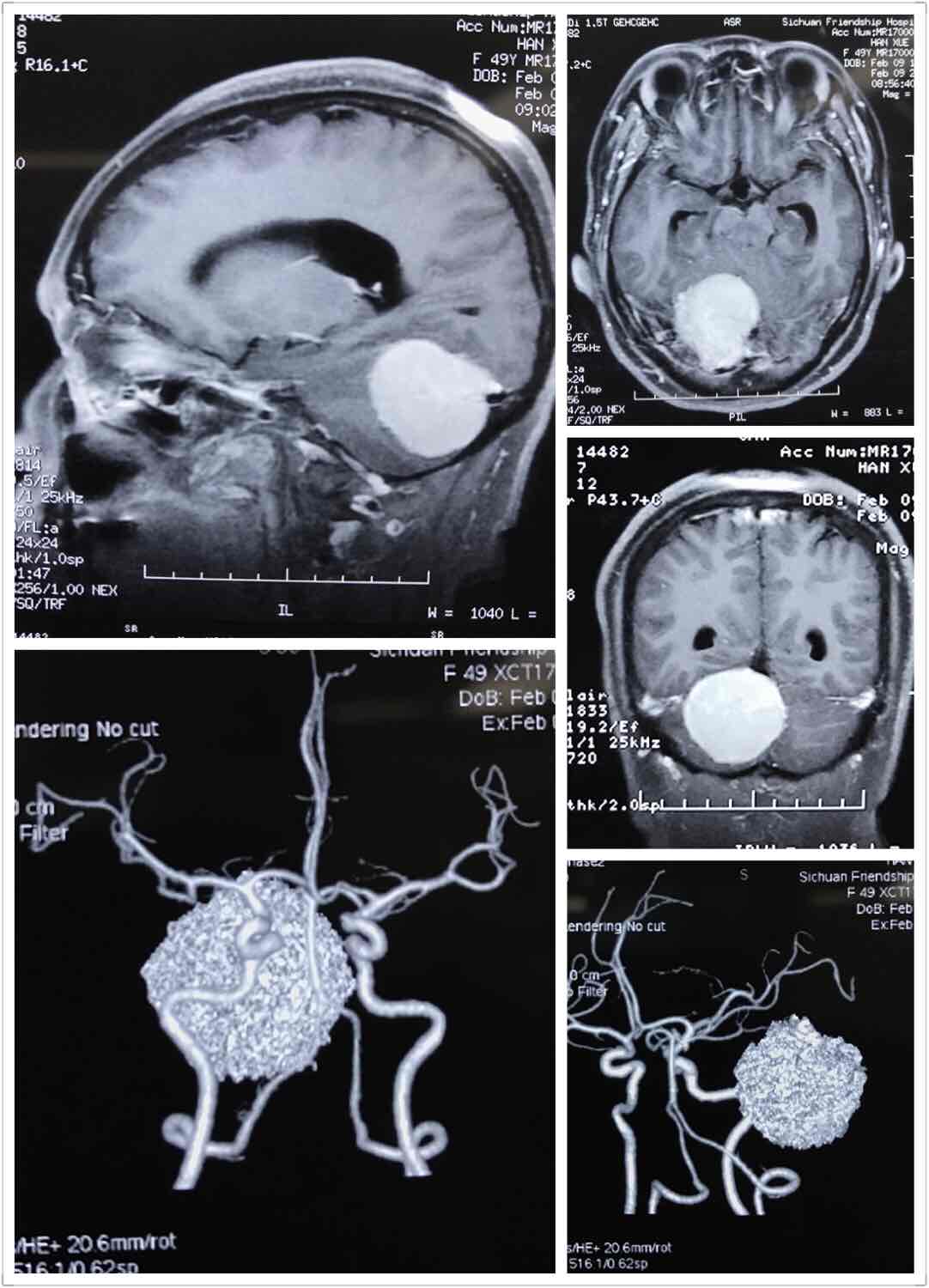 右侧小脑幕脑膜瘤