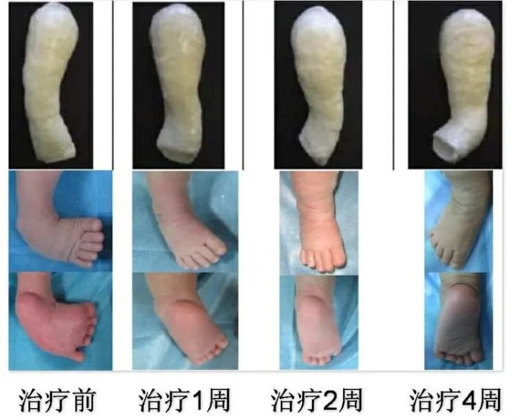 宝宝的脚像"马蹄",这种病要早治!
