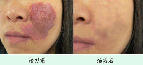 鲜红斑痣症状以及治疗