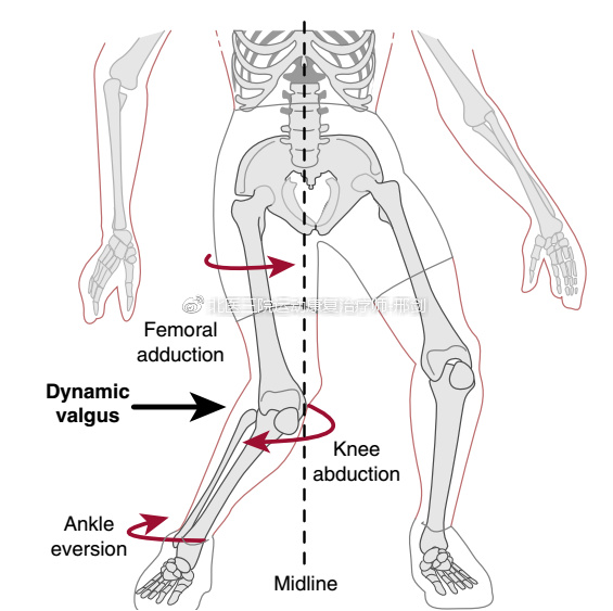 这一系列动作会增加膝关节外翻应力,而增加的应力负荷会导致前交叉