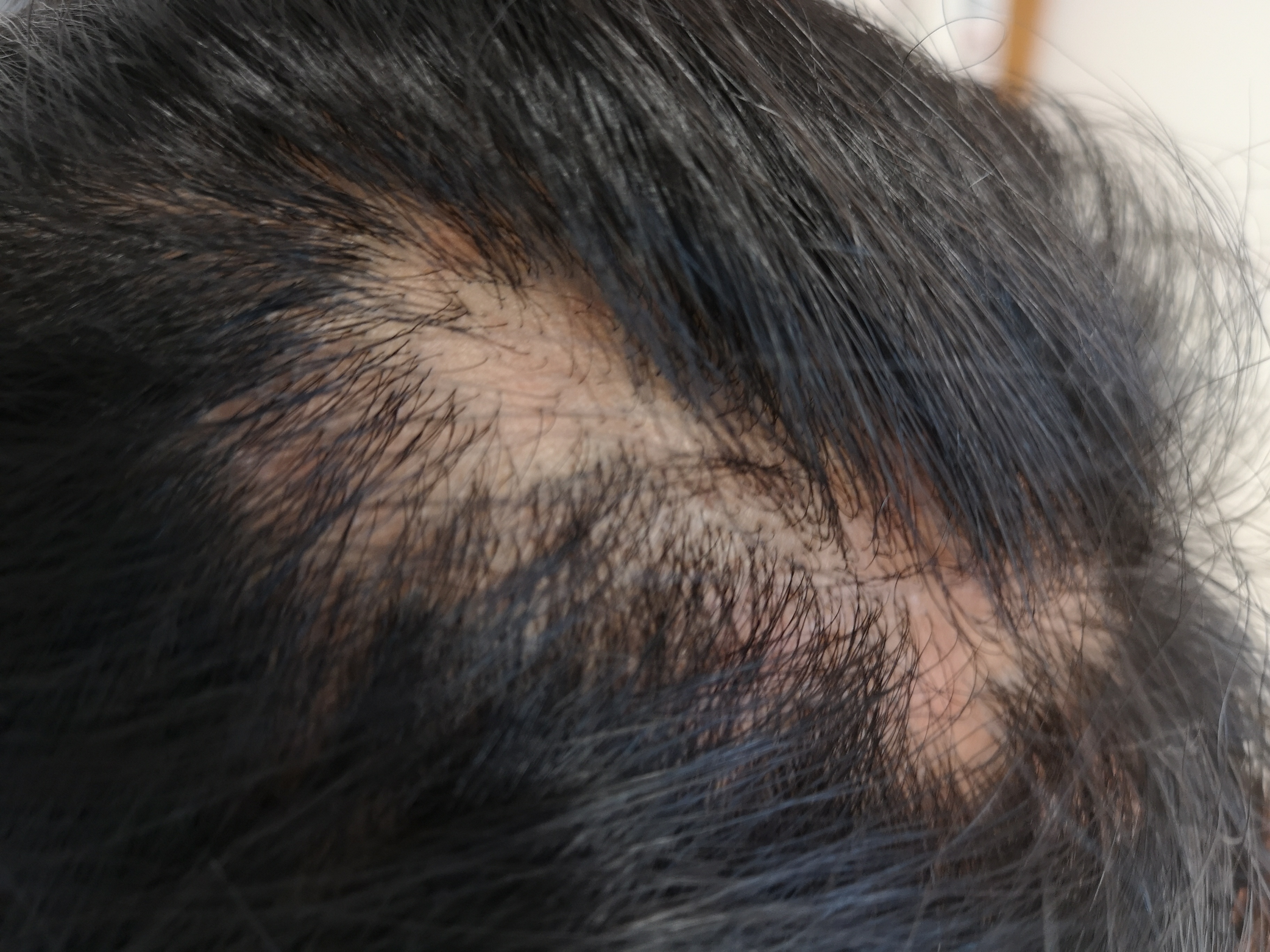 休止期脱发也很常见,尤其是产后及营养状况不佳等容易导致
