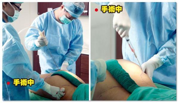 香港女商人在台做抽脂手术猝死,抽脂手术等同于减肥?