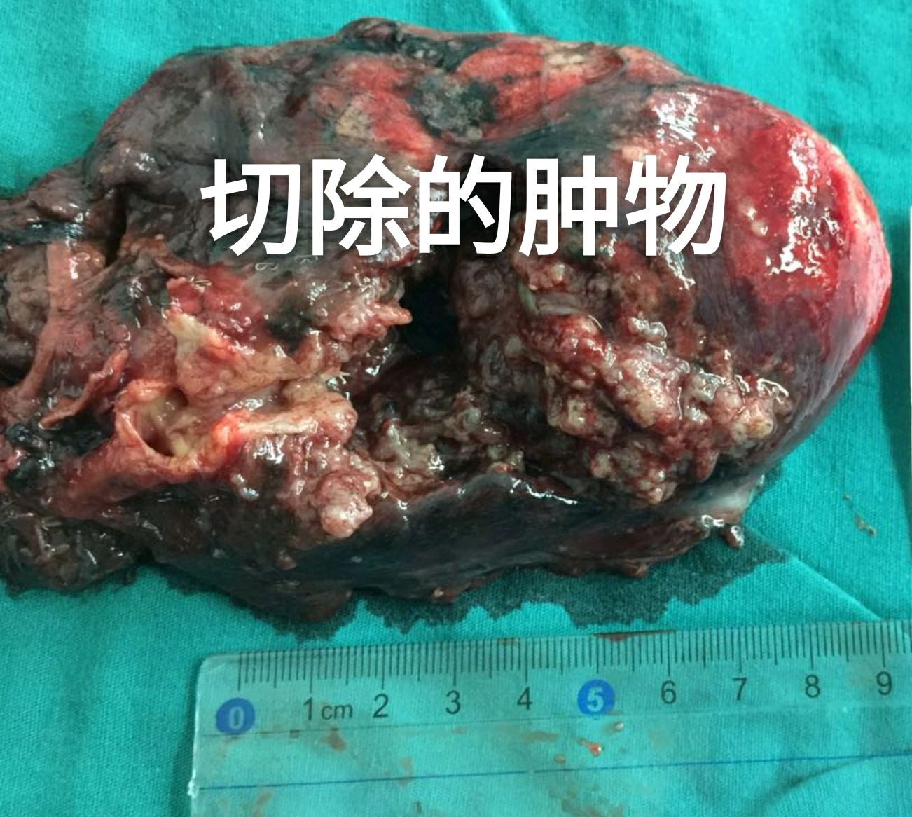 我们单孔最大切除的肺癌肿物,直径已经达到了接近9厘米.