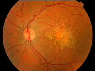 科普丨后葡萄膜炎,全葡萄膜炎易致盲