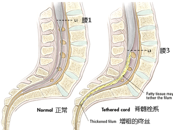 如脊髓縱裂,硬脊膜內脂肪瘤及脊髓脊膜膨出等導致;繼發性脊髓拴系綜合