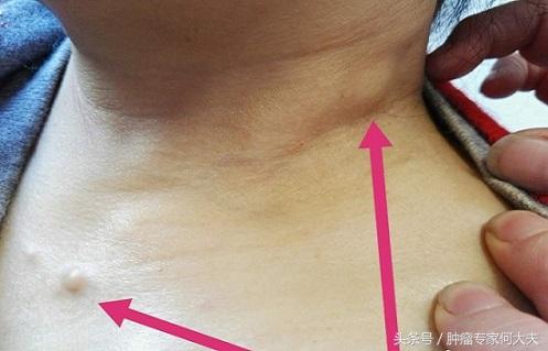 身上长了这种结节,千万不要大意,有些时候就是癌症皮肤转移