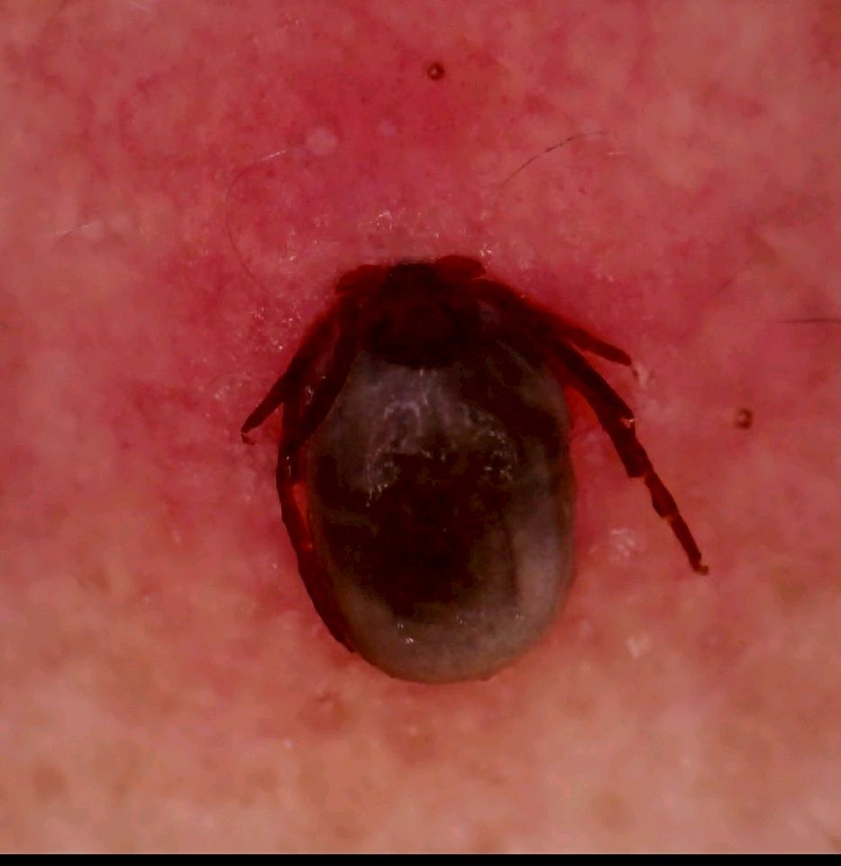 蜱虫钻进皮肤里,该不该用烟头烫?