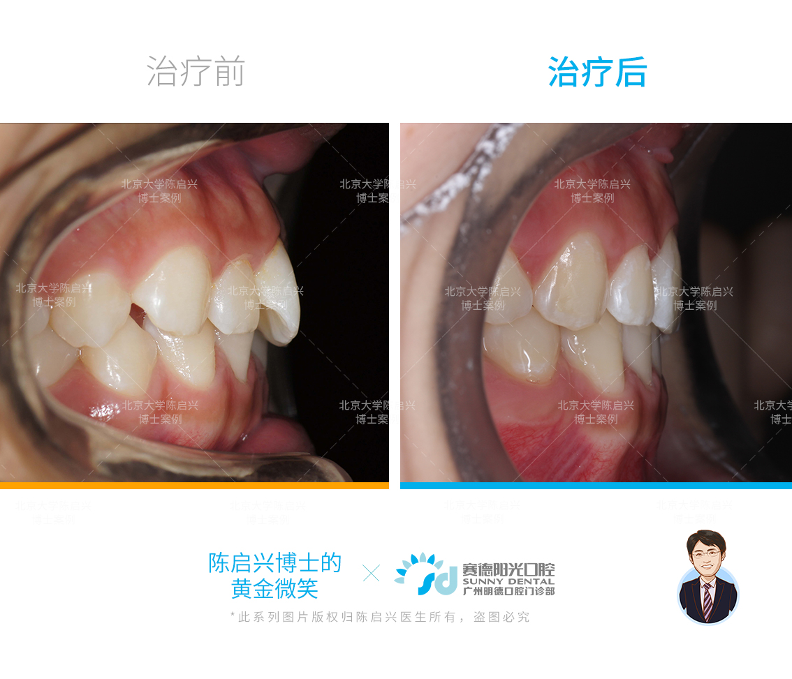 牙齿拥挤 门牙扭转 深覆合露龈笑矫正案例-陈启兴副主任医师-爱问医生