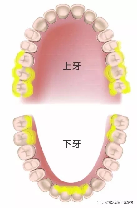 牙结石又称牙石,通常存在于唾液腺开口处的牙齿表面.