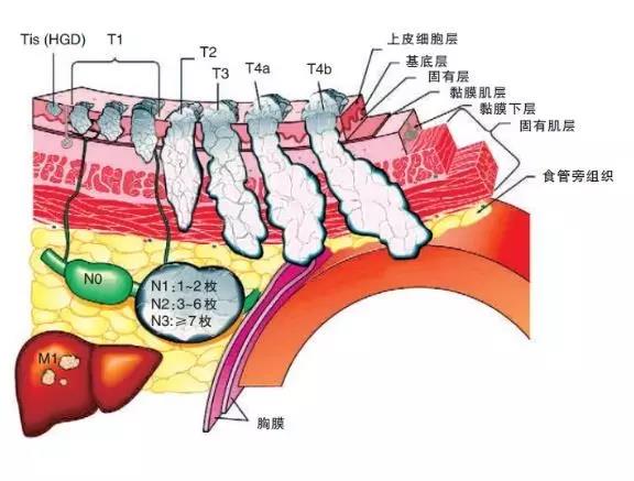 食管分4层,从内而外,有粘膜层,粘膜下层,肌肉层,外膜层