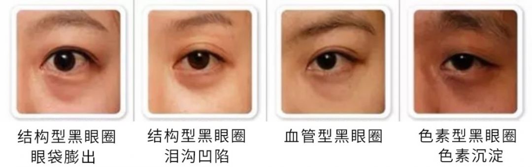 黑眼圈 | 三种类型,你属于哪种?