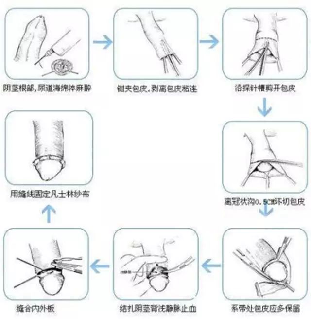 割完包茎恢复图大人图片