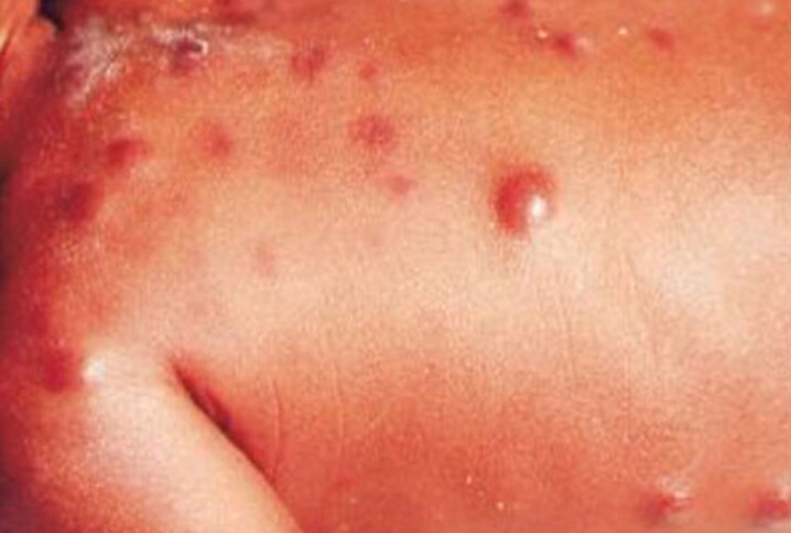 痱子的八卦(科普版)