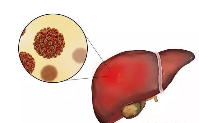 乙肝大三阳和小三阳,该如何区分?哪种更不易治愈?要引起重视!
