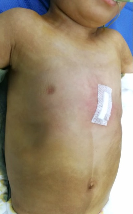 2岁漏斗胸wang手术:"前胸贴后背",极其严重-王文林主任医师-爱问医生