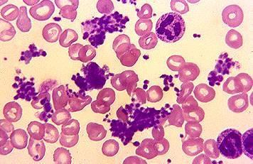 过敏性紫癜血小板数量增高,原因为何?