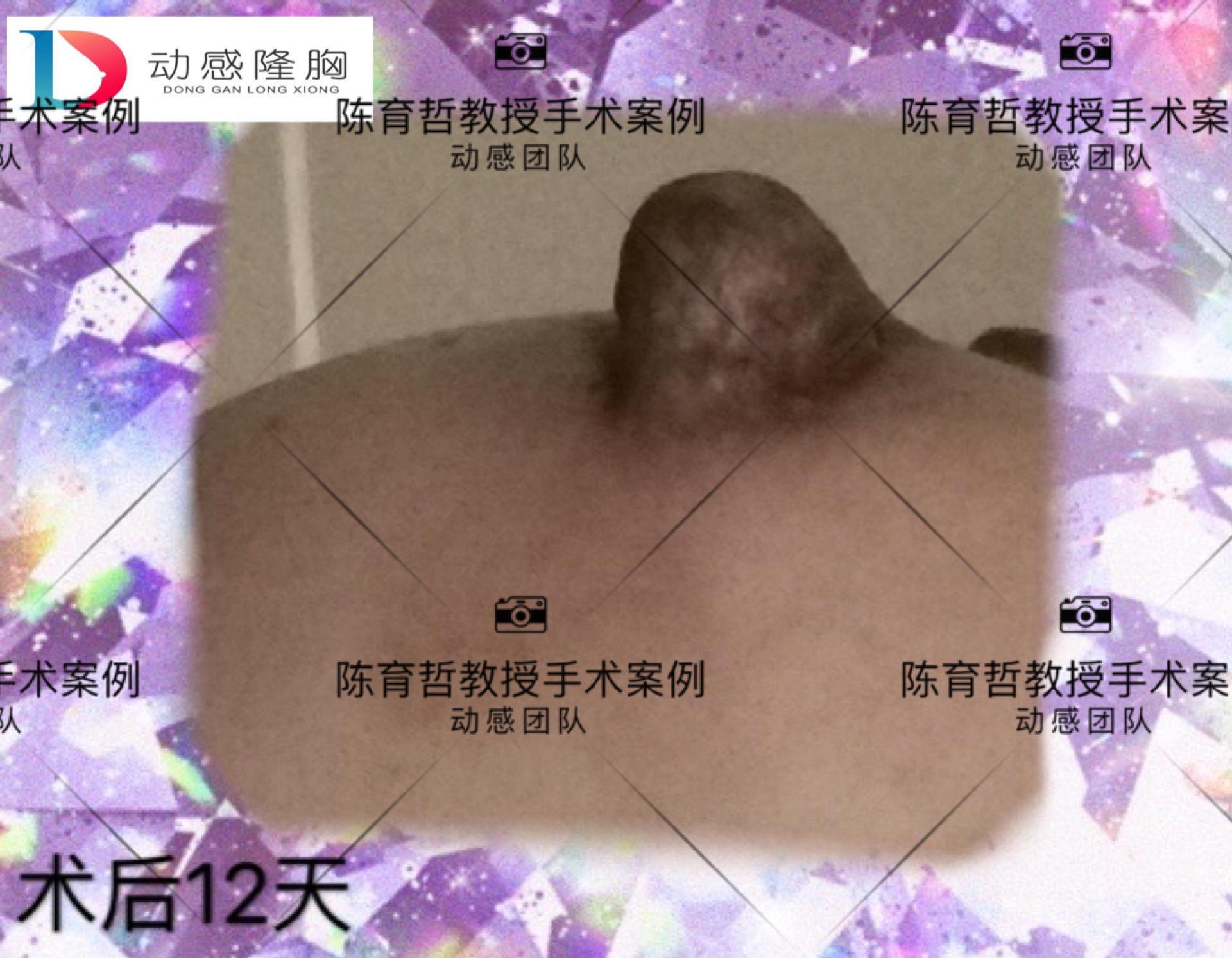 报告一例乳晕发育异常修复手术