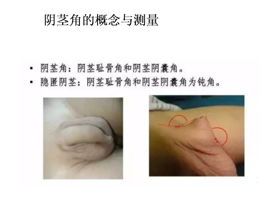 男性假两性畸形病能治愈吗_男性假两性畸形是什么意思_男性假两性畸形手术为女性