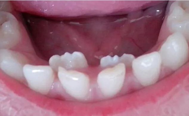 吃的食物过于精细,经常导致新牙从里面长出的时候乳牙还没有自行脱落