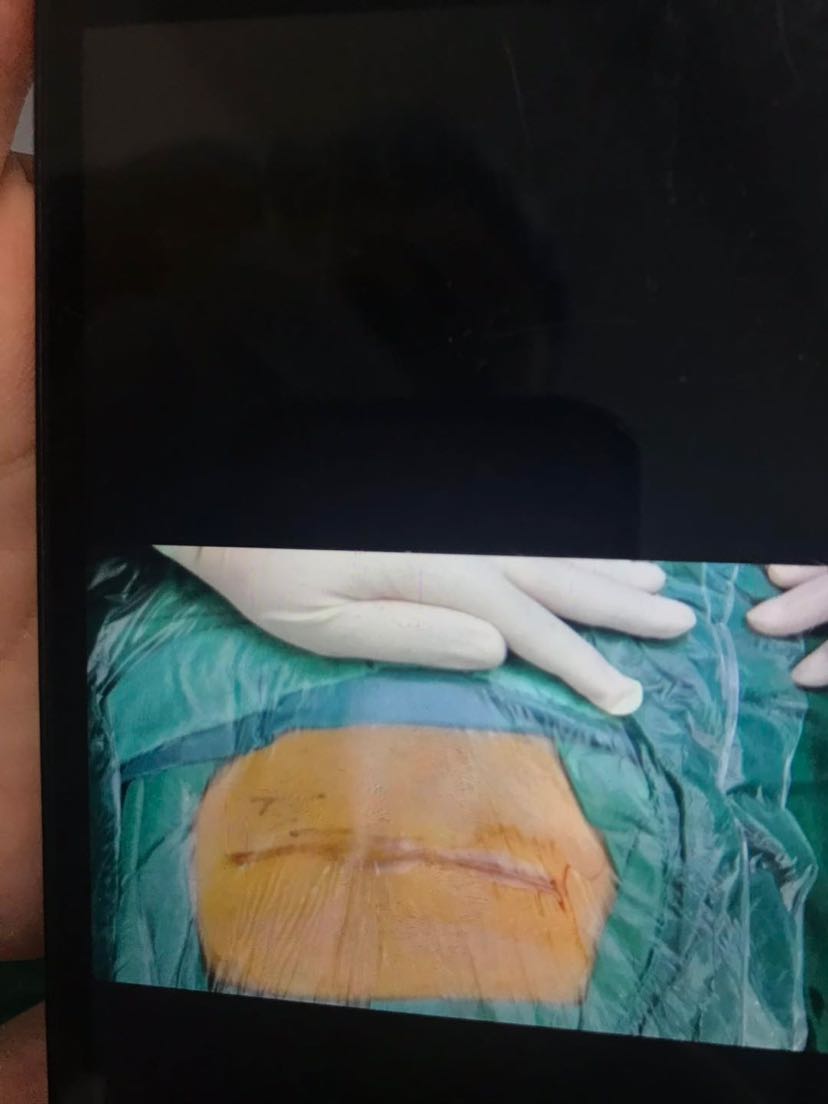 子宫肌瘤合并腹壁子宫内膜异位症开腹还是腹腔镜手术