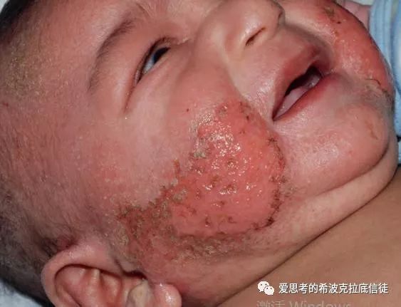 儿童湿疹该如何诊疗