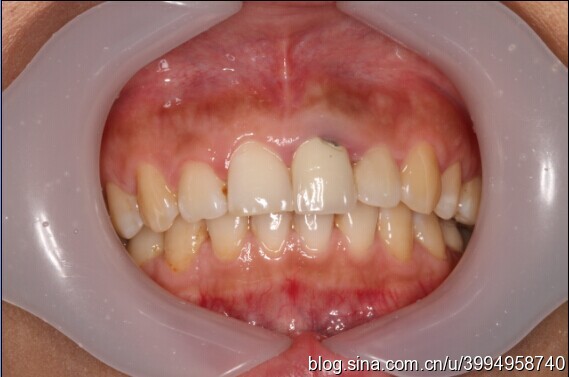 单颗前门牙全瓷修复仿真病例