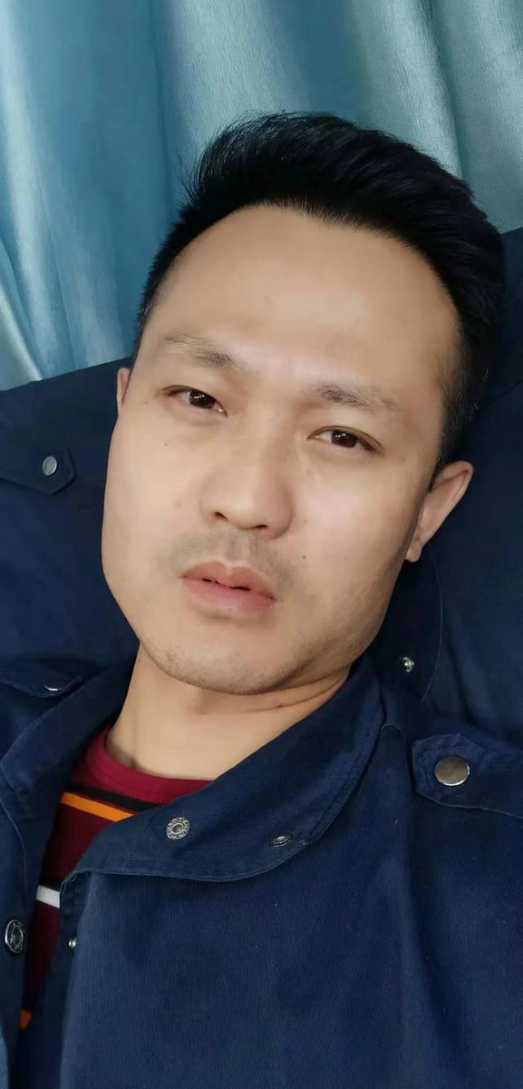 70后的帅大叔,身高1米8,厚头发变薄还后退,秃了,植发26