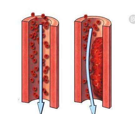 深静脉血栓,心梗,肺栓塞,周围动脉血栓以及各种原因的血液高凝状态等