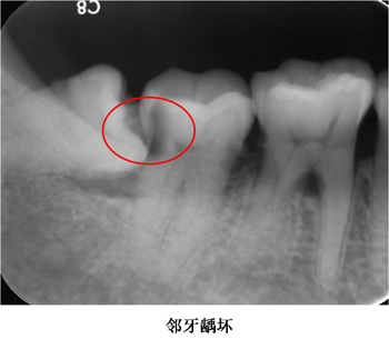 萌出不全或阻生時,牙冠周圍軟組織發生的炎症,常發生在下頜第三磨牙