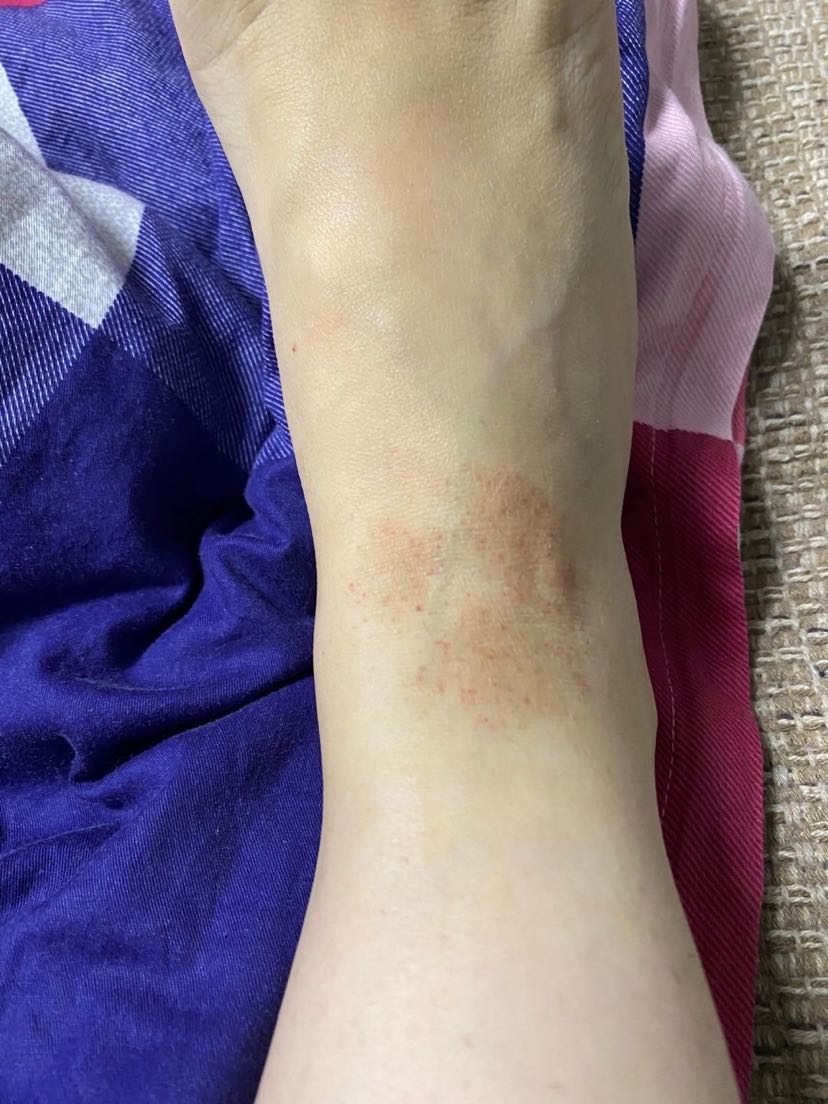 疫情期间洗澡过多当心乏脂性性湿疹的发生