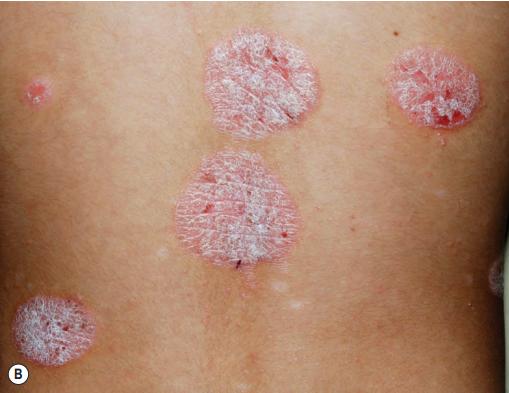 银屑病(牛皮癣)是什么样的疾病?