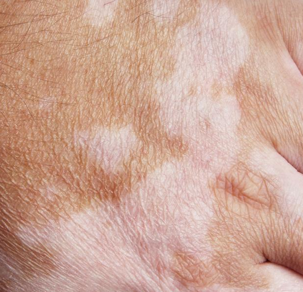 皮肤长白斑不一定是白癜风教你辨别真假白癜风