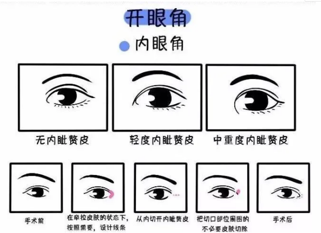眼综合包含哪些项目?可不止双眼皮这么简单哦!