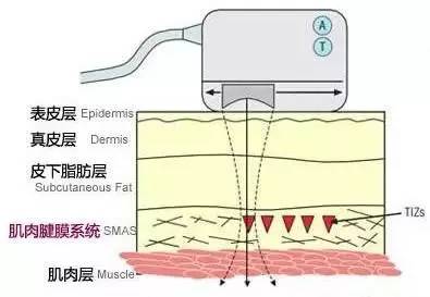超声刀和埋线提升哪个效果会更好