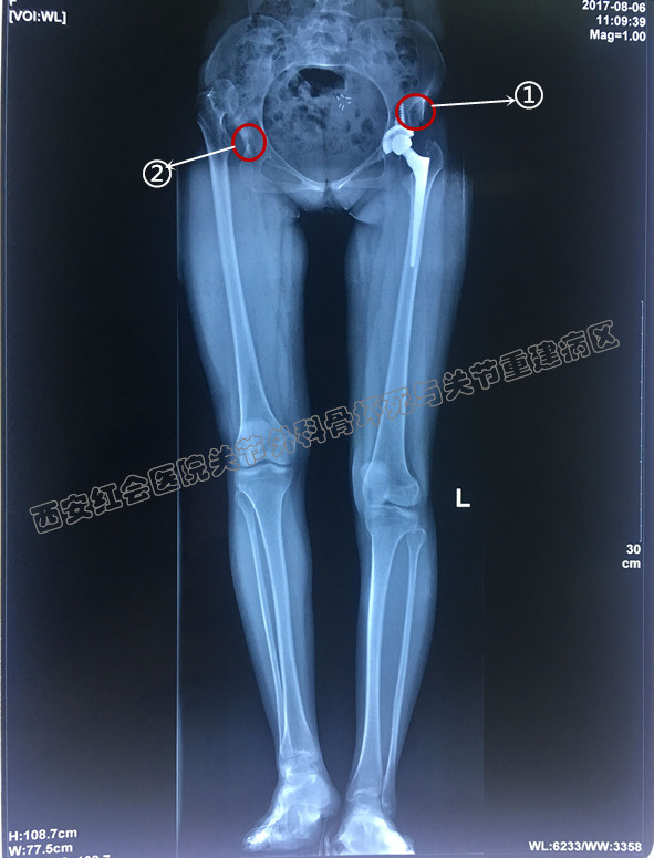 (圖)左側髖關節置換手術後一個月,①術前左側異常位置,此次手術將右側