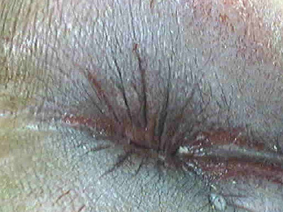 女性肛门湿疹图图片