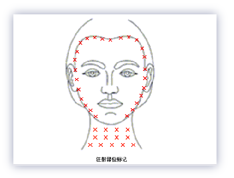 吉适肉毒素全面部轮廓提升
