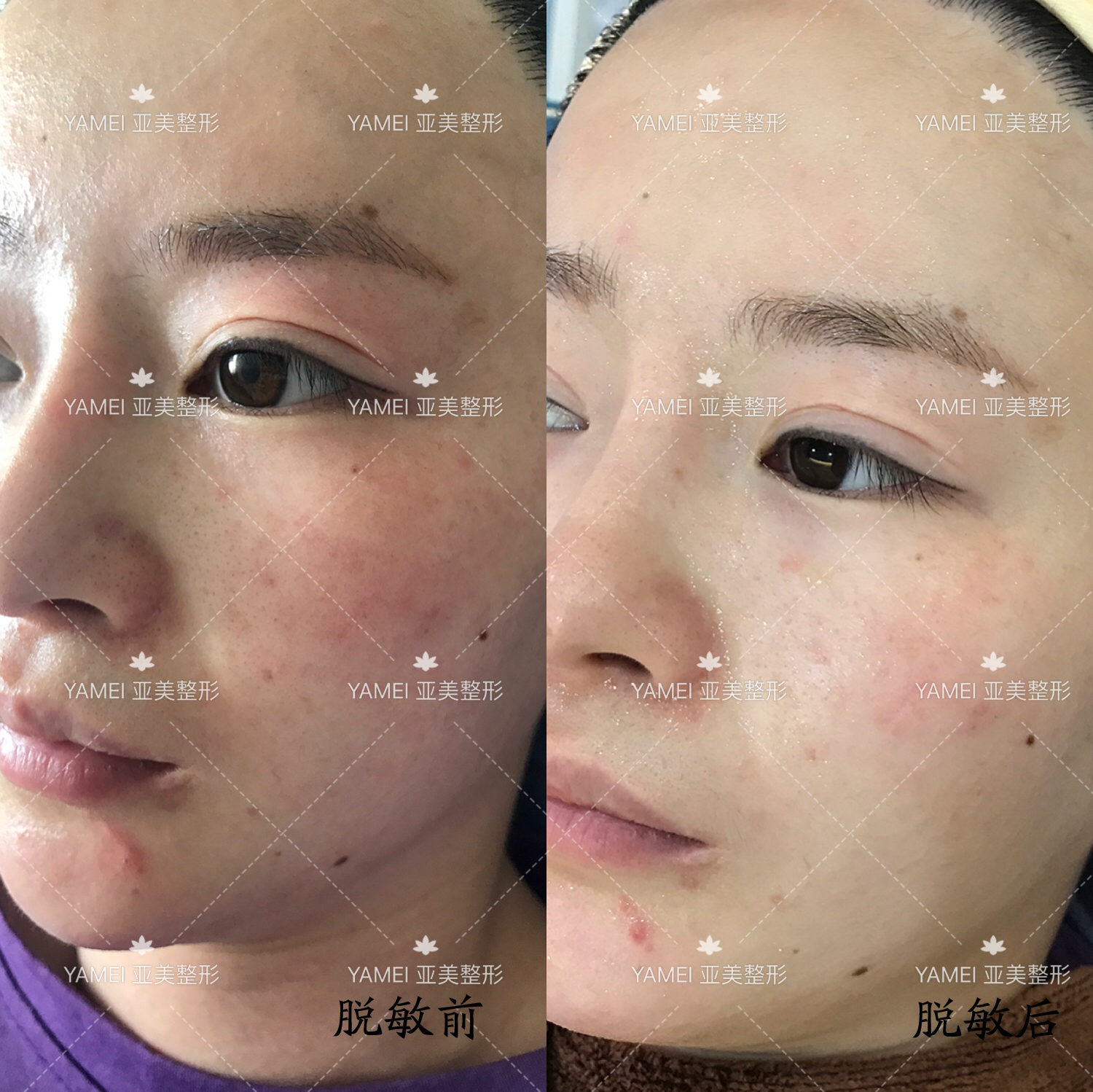 金华亚美皮肤管理前后过敏症状的辨识与解决