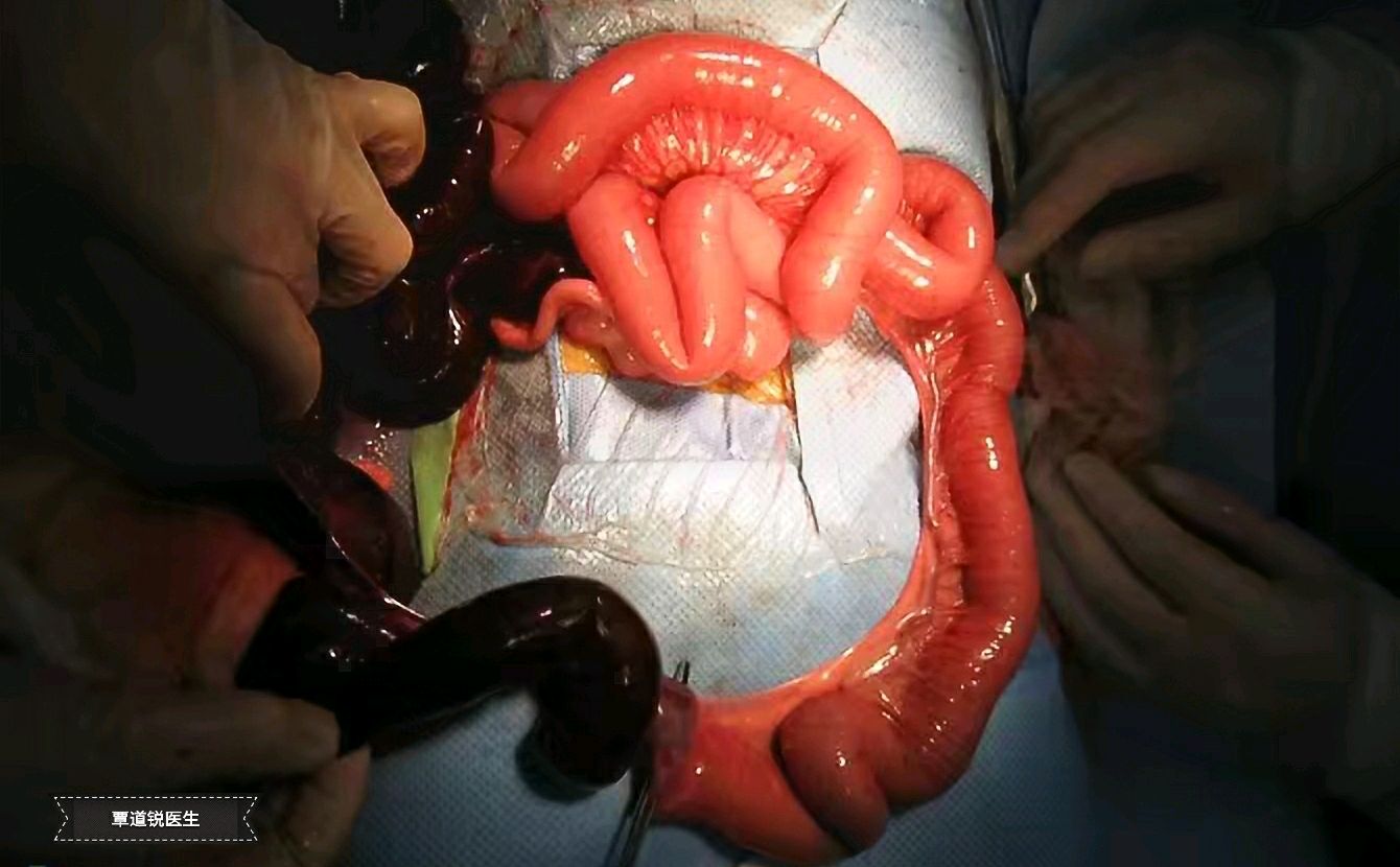 新生儿肠梗阻图片