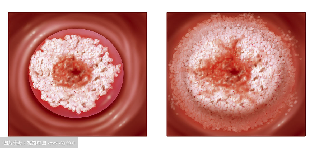 25岁白领确诊宫颈癌不喝酒不抽烟医生说都是男友害的