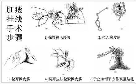 肛瘘挂线皮筋脱落图片图片