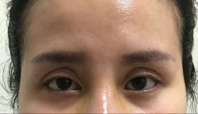 后天性眼睑凹陷是指眼睑整形术中,过度切除眶隔脂肪或眼轮匝肌导致的