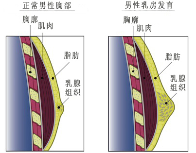 男性乳房发育症