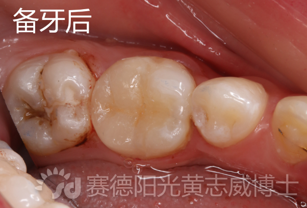 医生我蛀牙了牙齿留下的洞该怎么办