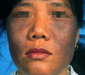 黑变病一,诊断要点黑变病属于色素障碍性皮肤病,与祖国医学记载的黧黑