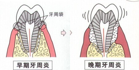 怎样预防牙周病?