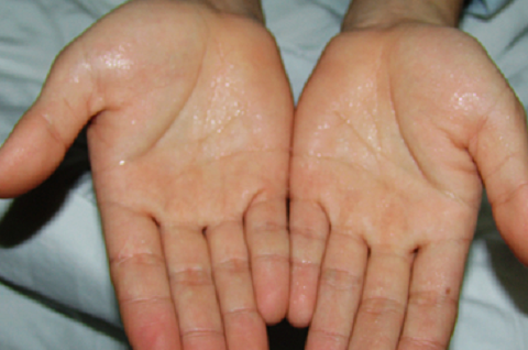 了解一下手汗症看看怎么治疗