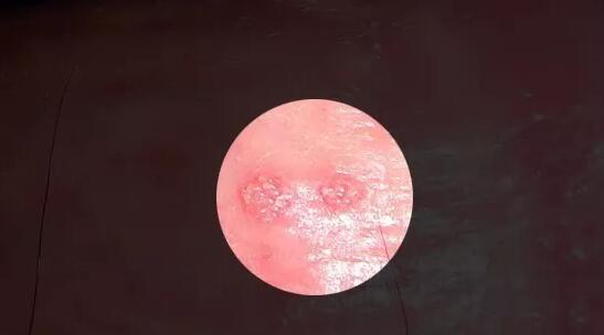 尖锐湿疣复发会扩大生长范围吗