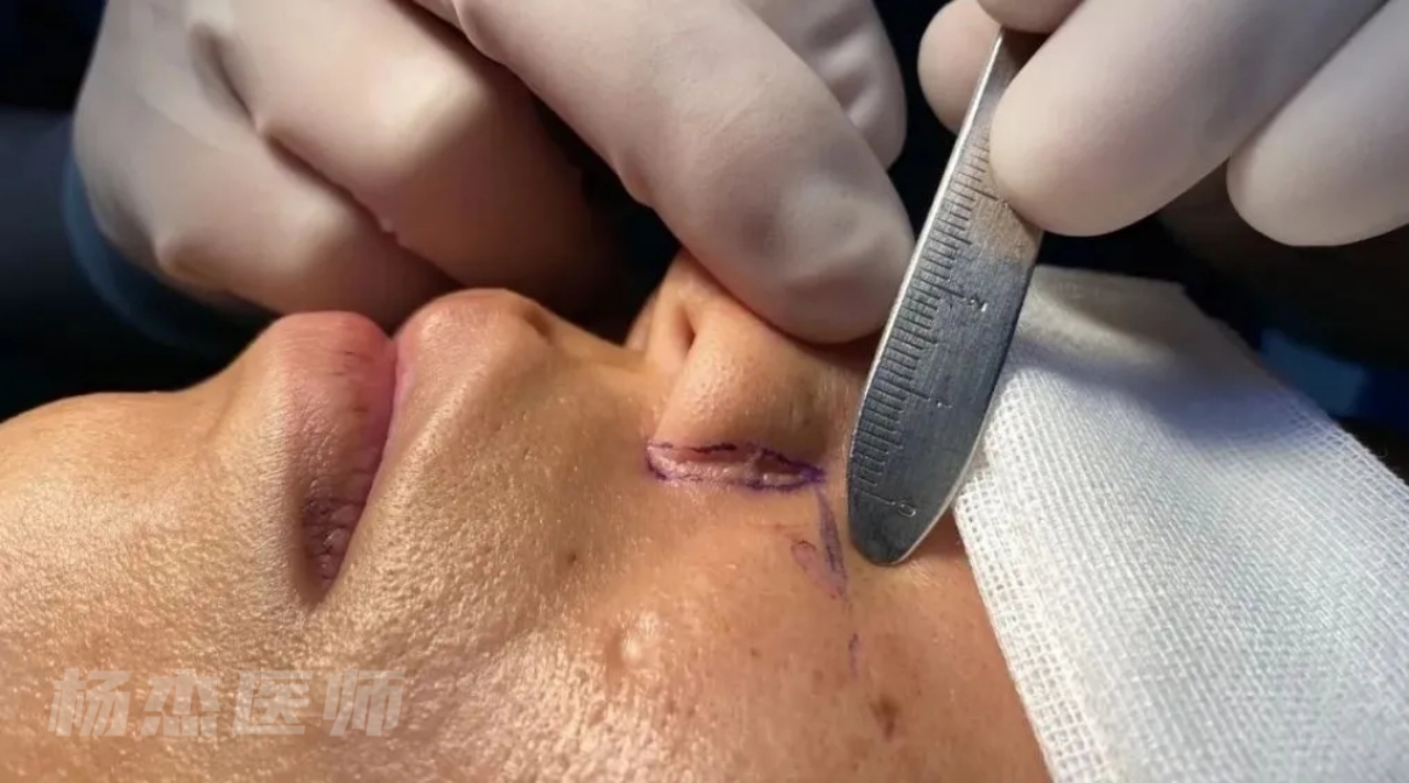 鼻翼疤痕修复|常见鼻翼疤痕类型及原因分析